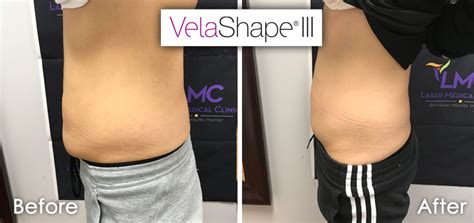 velashape austin